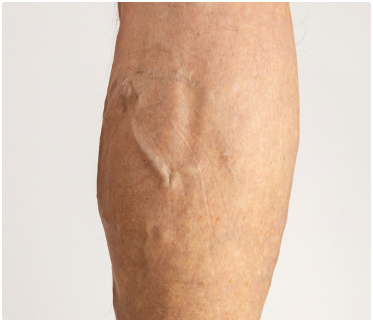 After treatment