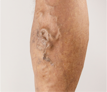 Before treatment