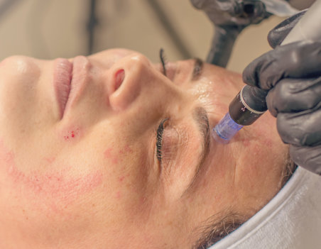Needle mesotherapy treatment on a woman face. Beauty treatment.