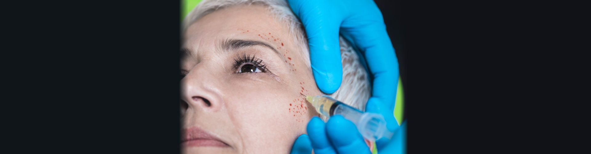 PRP Face Cosmetics Injecting.